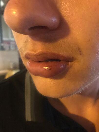 Brutalo-Attacke im Bierkönig am Ballermann. Erst feierte Christoph S., dann wurde er vom Türsteher brutal verprügelt.