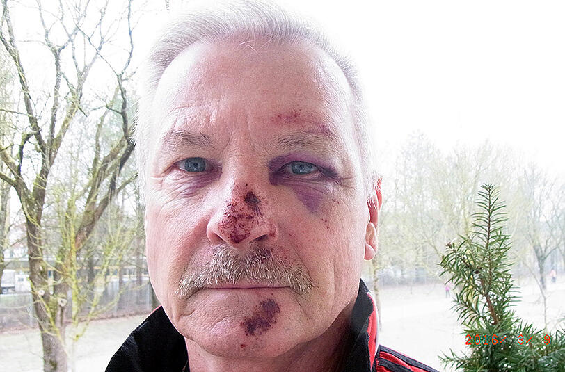 Hans-Eberhard Kröbel (66) ist mit dem Gesicht auf dem Boden aufgeschlagen, nachdem ein wildgewordener Autofahrer den Radler ausgebremst hat.