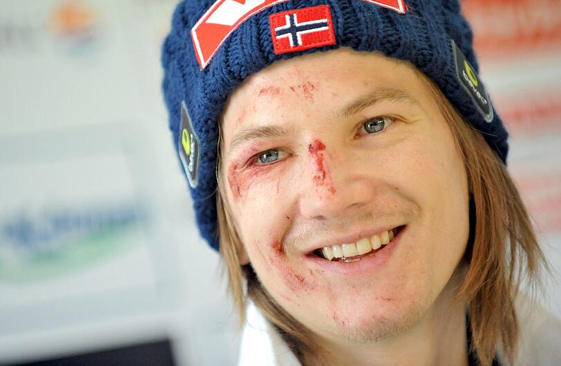 Die Spuren des Horror-Sturzes sind ins Gesicht von Tom Hilde gezeichnet. Doch der Norweger kann schon wieder lachen.