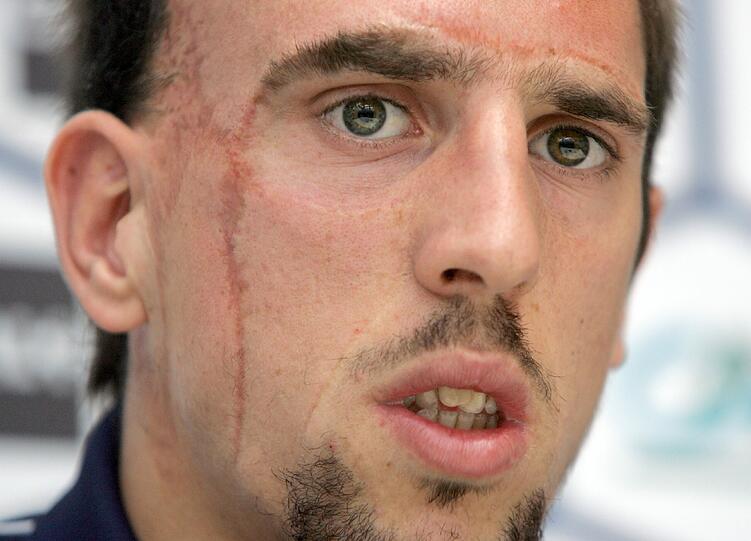 Der 2-Jährige Ribery ist mit seinen Eltern im Auto unterwegs. Die Familie hat einen Unfall. Franck sitzt hinten und kracht mit dem Kopf gegen die Windschutzscheibe. Daher auch seine markante Narbe im Gesicht.