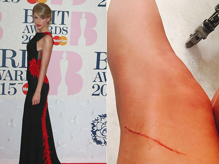 Autsch! Das sieht aber böse aus. Ein roter Kratzer ziert ein Bein von Taylor Swift