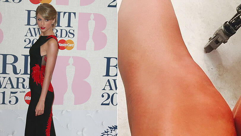 Autsch! Das sieht aber böse aus. Ein roter Kratzer ziert ein Bein von Taylor Swift Autsch! Das sieht aber böse aus. Ein roter Kratzer ziert ein Bein von Taylor Swift