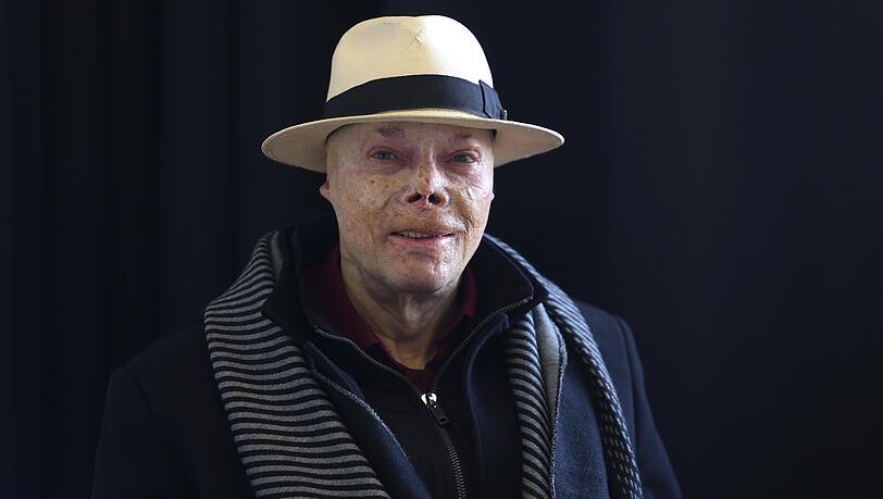 Seit seinem Feuer-Unfall tr&auml;gt Wolfgang einen Hut. Die Haut auf dem Kopf sei besonders d&uuml;nn und verletzlich geworden. Trotz allem hat er weiter Humor: &bdquo;Der Arzt hat irgendwas falsch verdrahtet. Wenn ich mein Kinn anfasse, sp&uuml;re ich das neben meinem Auge&ldquo;, sagt er.