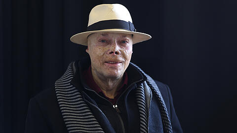 Seit seinem Feuer-Unfall tr&auml;gt Wolfgang einen Hut. Die Haut auf dem Kopf sei besonders d&uuml;nn und verletzlich geworden. Trotz allem hat er weiter Humor: &bdquo;Der Arzt hat irgendwas falsch verdrahtet. Wenn ich mein Kinn anfasse, sp&uuml;re ich das neben meinem Auge&ldquo;, sagt er.