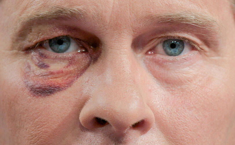 Hinnerk Baumgarten ist noch immer von der Prügelattacke gezeichnet