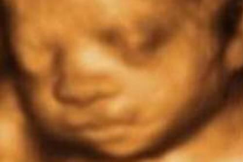 Das Koma-Baby in der 22. Schwangerschaftswoche: Per 3-D-Ultraschall machten die Ärzte dieses faszinierende Foto aus dem Bauch der Mutter. 12 Wochen später wurde der Bub geboren.