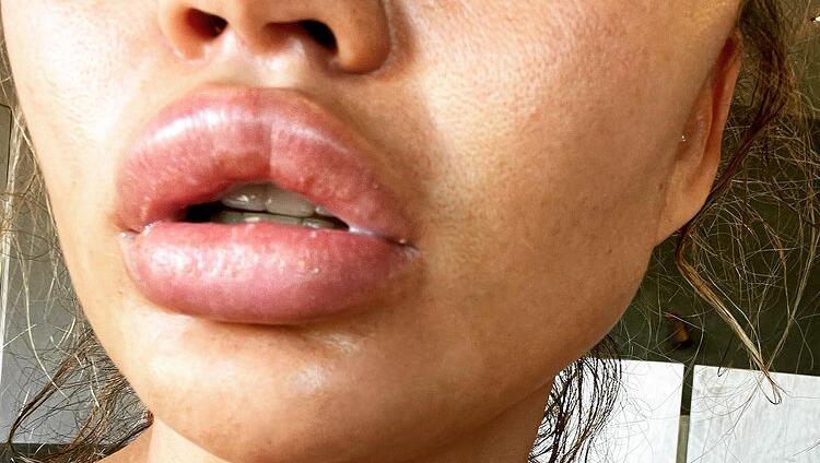 Auf Instagram präsentiert Chrissy Teigen ihren 34 Millionen Followern ihre geschwollenen Lippen. Was ist passiert?
