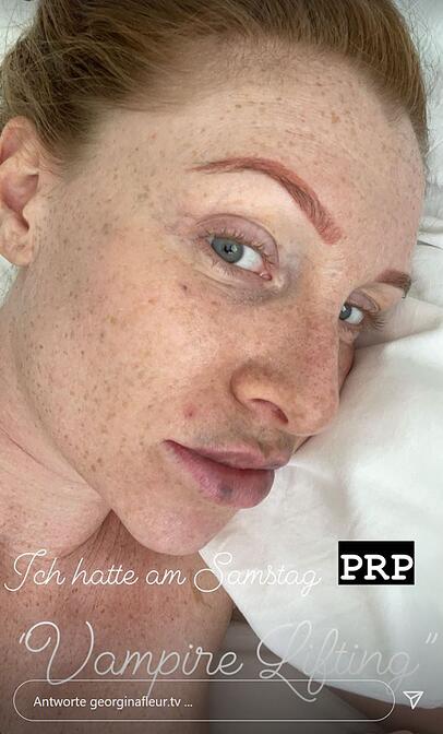 Georgina Fleur hat nach dem Vampir-Lifting ein geschwollenes Gesicht und blaue Lippen. Georgina Fleur hat nach dem Vampir-Lifting ein geschwollenes Gesicht und blaue Lippen.