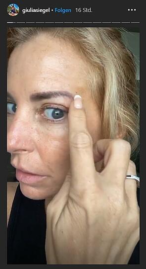 Drei Tage nach der Lidstraffung präsentiert Giulia Siegel das vorläufige Ergebnis.