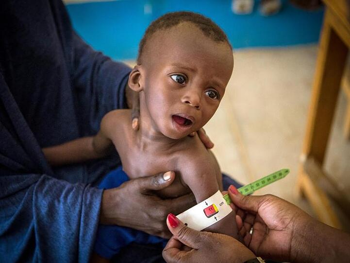 Im Gesundheitszentrum von Gao (Mali) wird der arm eines schwer unterernährten, 16 Monate alten Kindes vermessen.