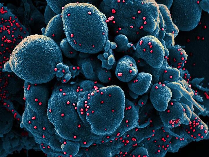 Eine mit SARS-CoV-2 infizierte Zelle. Möglicherweise gab es in Frankreich schon im Dezember einen Coronavirus-Fall.