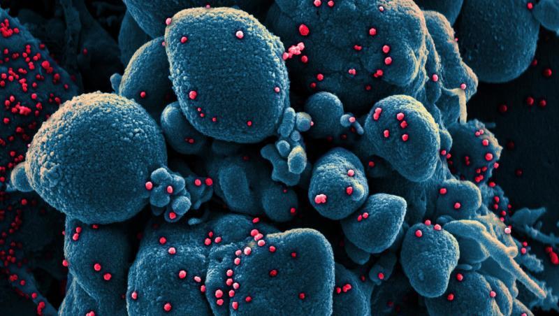 Eine mit SARS-CoV-2 infizierte Zelle. Möglicherweise gab es in Frankreich schon im Dezember einen Coronavirus-Fall. Eine mit SARS-CoV-2 infizierte Zelle. Möglicherweise gab es in Frankreich schon im Dezember einen Coronavirus-Fall.