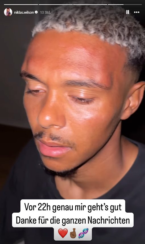 Auf seinem Instagram-Accout zeigt Nürnberger Spieler Niklas-Wilson Sommer die Folgen des Angriffs auf ihn in einer Story. Nach Einschätzung des FC Nürnberg ist die Tat eine Reaktion darauf, "dass sich der Spieler drei Tage zuvor in einem Bayern-Trikot in den sozialen Netzwerken gezeigt hat.