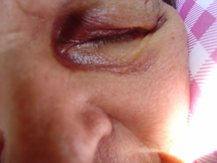 ...und blauem Auge.