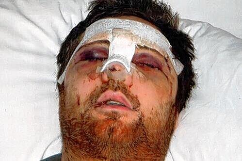Augenhöhlen, Joch- und Nasenbein sowie der Kiefer waren gebrochen: In der Uni-Klinik Erlangen musste Christian K. nach dem Brutalo-Foul dreimal operiert werden.