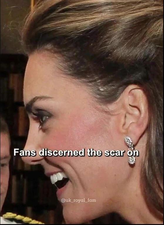 Hier deutlich zu sehen: Prinzessin Kate hat eine lange Narbe über dem linken Ohr. Hier deutlich zu sehen: Prinzessin Kate hat eine lange Narbe über dem linken Ohr.