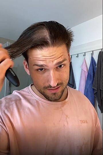 Auf Instagram zeigt Marco Cerullo seine kahlen Stellen auf dem Kopf.