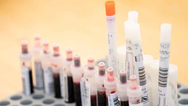 Entnommene Abstrichtests und Blutproben. Foto: Kay Nietfeld/dpa/Symbolbild Entnommene Abstrichtests und Blutproben. Foto: Kay Nietfeld/dpa/Symbolbild