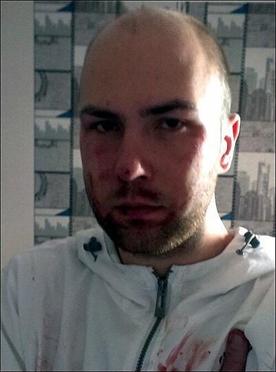 Nach dem Überfall: Konstantyn M.s Gesicht ist geschwollen, die Lippe eingerissen.