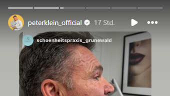 Peter Klein zeigte das Ergebnis seines Eingriffs in einer Instagram-Story. Peter Klein zeigte das Ergebnis seines Eingriffs in einer Instagram-Story.