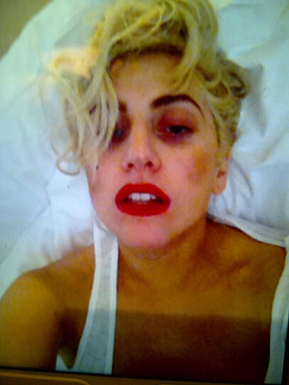Einer ihrer Tänzer hatte die Sängerin am Montag im Rahmen der spektakulären Gaga-Bühnenshow mit einer Eisenstange am Kopf getroffen - das ist das Ergebnis. Neben dem Veilchen erlitt Lady Gaga bei dem Zwischenfall auch eine Gehirnerschütterung. Dennoch will sie schon bald wieder auf der Bühne stehen.