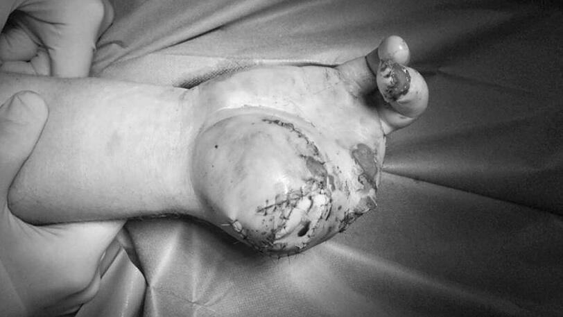 Eine kleine Hand, von einer Silvesterrakete schwer verletzt. Mit diesem Foto warnte das Klinikum Dortmund auf Twitter und Facebook vor möglichen Gefahren.