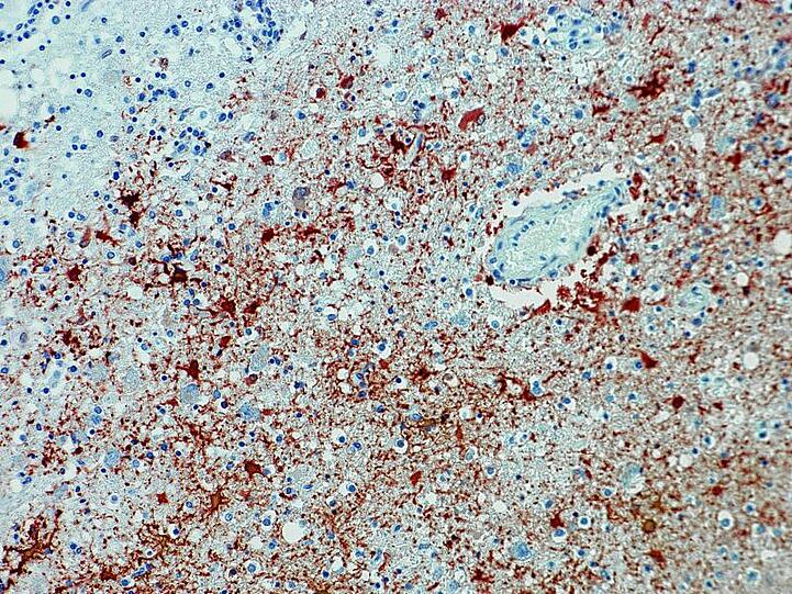 Anitkörpernachweis zum Borna-Virus im Gewebe. Foto: Bernhard-Nocht-Institut für Tropenmedizin/dpa