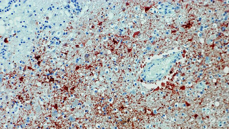 Anitkörpernachweis zum Borna-Virus im Gewebe. Foto: Bernhard-Nocht-Institut für Tropenmedizin/dpa Anitkörpernachweis zum Borna-Virus im Gewebe. Foto: Bernhard-Nocht-Institut für Tropenmedizin/dpa