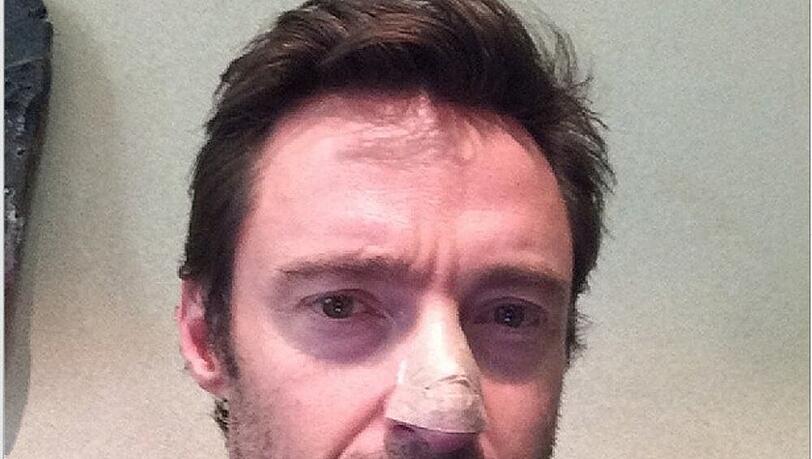 Dieses Bild postete Schauspieler Hugh Jackman nach dem Eingriff Dieses Bild postete Schauspieler Hugh Jackman nach dem Eingriff