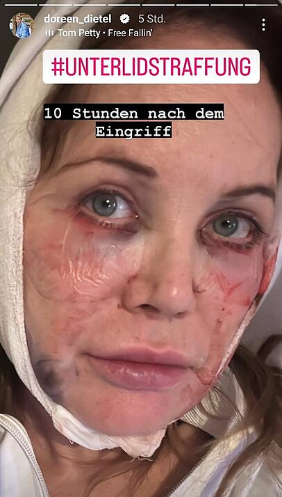 Doreen Dietel gibt einen ungeschönten Einblick in die Folgen ihrer Beauty-Behandlung. Doreen Dietel gibt einen ungeschönten Einblick in die Folgen ihrer Beauty-Behandlung.