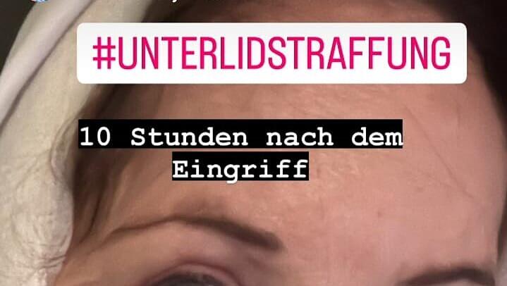 Doreen Dietel gibt einen ungeschönten Einblick in die Folgen ihrer Beauty-Behandlung. Doreen Dietel gibt einen ungeschönten Einblick in die Folgen ihrer Beauty-Behandlung.