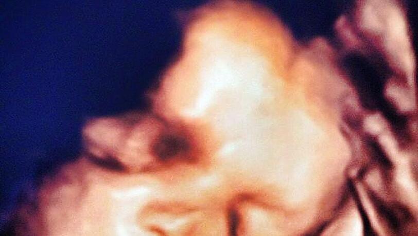 Dieses Ultraschall-Foto veröffentlichte Willi Herren auf Facebook Dieses Ultraschall-Foto veröffentlichte Willi Herren auf Facebook