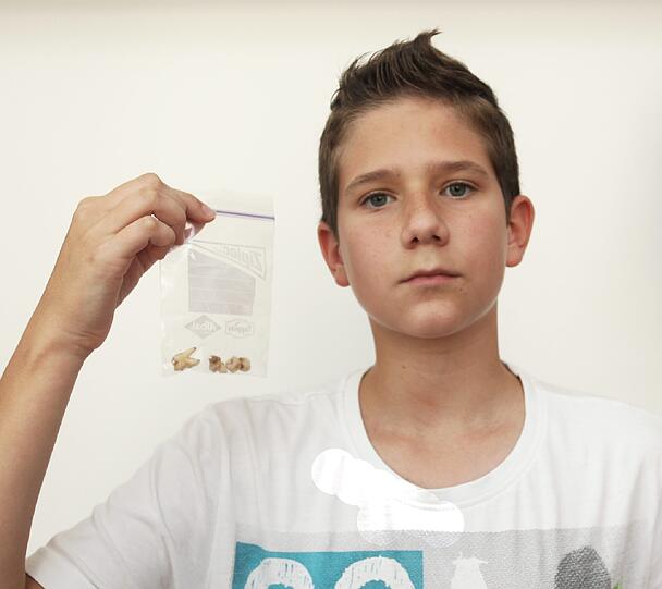 Maximilian S. (13) wurden drei Weisheitszähne und eine gesunder Backenzahn gezogen. Der vierte Weisheitszahn sitzt noch im Kiefer