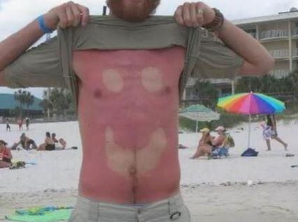 Der #sunburnart-Trend verbreitet sich auf Twitter rasend schnell. Hautärzte warnen vor den Gefahren.