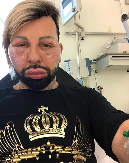 Allergische Reaktion: Harald Glööckler musste in eine Klinik.