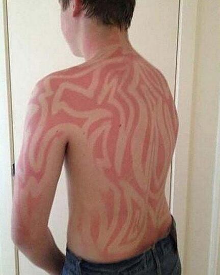 Der #sunburnart-Trend verbreitet sich auf Twitter rasend schnell. Hautärzte warnen vor den Gefahren.