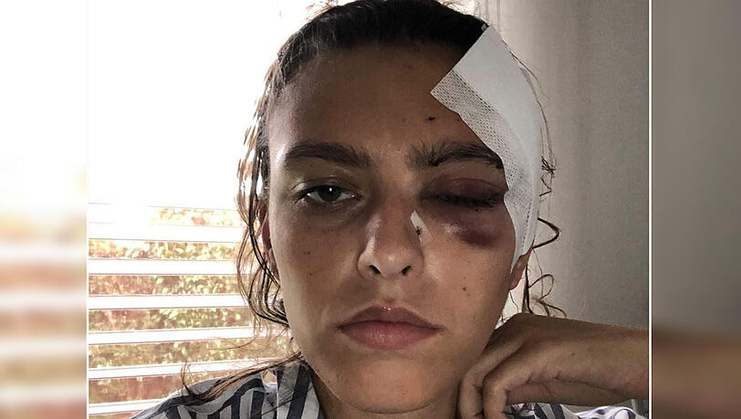 Vanessa Hampl zeigt der AZ ihre schweren Verletzungen