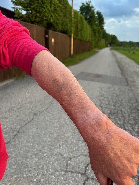 An Holzapfels Unterarm kann man noch blaue Flecken sehen. An Holzapfels Unterarm kann man noch blaue Flecken sehen.