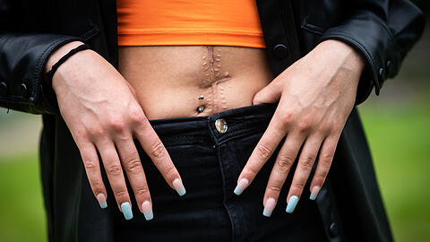Diese junge Frau wurde mit einem Messer angegriffen. Die lange Narbe am Bauch wird sie für immer an den Mordversuch erinnern.