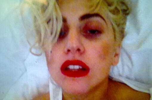 Mit einem blauen Auge davon gekommen: Nach dem Bühnenunfall bei ihrem letzten Konzert twittert Lady Gaga und zeigt aller Welt ihre Blessuren - die Bilder.