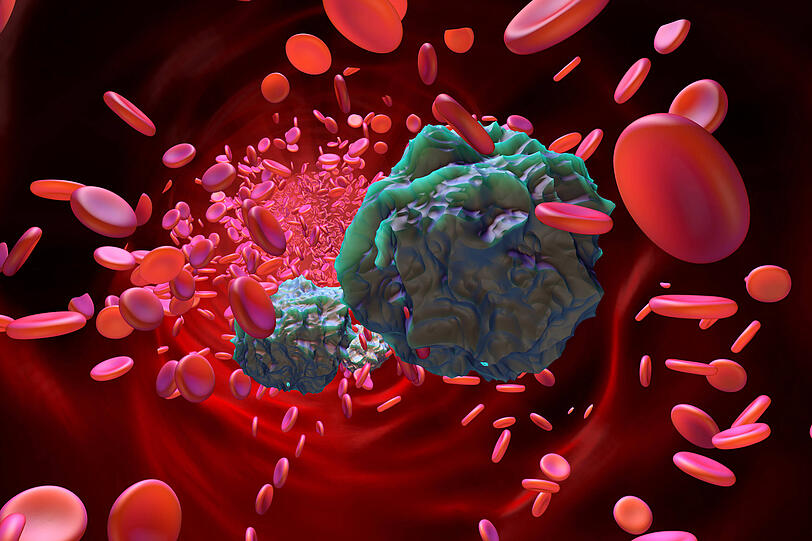 Eine Illustration von Leuk&auml;mie-Zellen.