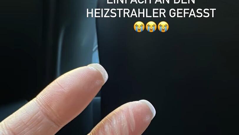Üble Verbrennungen an den Fingern: Joelina zeigt ihre Verletzungen Üble Verbrennungen an den Fingern: Joelina zeigt ihre Verletzungen