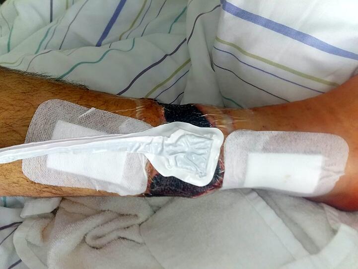 Ein Stück der Wade ist herausgerissen, daneben hat sich Bauer mehrere Knochen gebrochen.