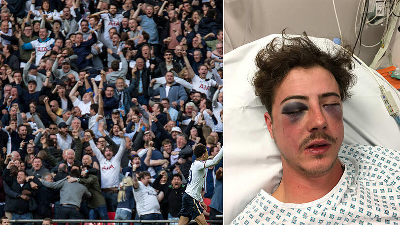 Tottenham-Hooligans haben Michael Vollmer ordentlich zugerichtet.