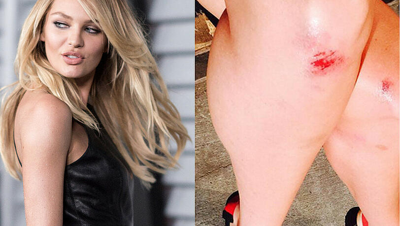 Candice Swanepoel: Kleine Kratzer nach dem Sturz auf der Fashion-Show Candice Swanepoel: Kleine Kratzer nach dem Sturz auf der Fashion-Show