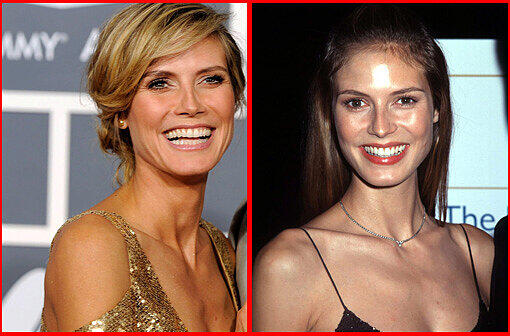 Ein Beauty-Doc behauptet: Ja, sie hatte eine Nasen-OP! Sehen Sie die Veränderung der Heidi Klum in unserer Galerie.