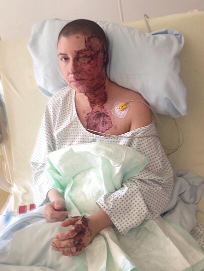 Wenige Tage nach der Attacke: Das private Foto zeigt Vanessa im Februar 2016 in der Medizinischen Hochschule Hannover MHH in Hannover.