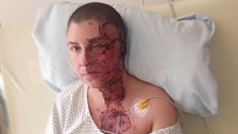 Wenige Tage nach der Attacke: Das private Foto zeigt Vanessa im Februar 2016 in der Medizinischen Hochschule Hannover MHH in Hannover. Wenige Tage nach der Attacke: Das private Foto zeigt Vanessa im Februar 2016 in der Medizinischen Hochschule Hannover MHH in Hannover.