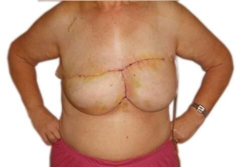 Dieses Foto des Uniklinikums München zeigt die operierte Frau - die linke Brust wurde komplett nachgebildet.