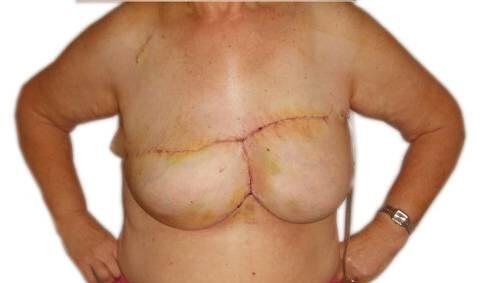 Dieses Foto des Uniklinikums München zeigt die operierte Frau - die linke Brust wurde komplett nachgebildet. Dieses Foto des Uniklinikums München zeigt die operierte Frau - die linke Brust wurde komplett nachgebildet.